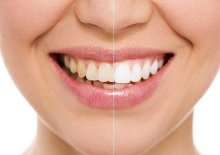 Image of Advanced teeth whitening treatment in Smyrna