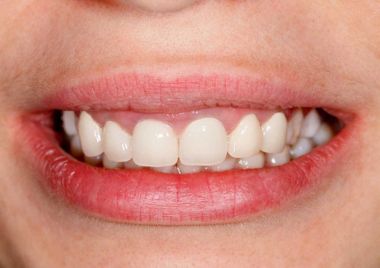Methods for teeth whitening explained by the dentist in Smyrna area