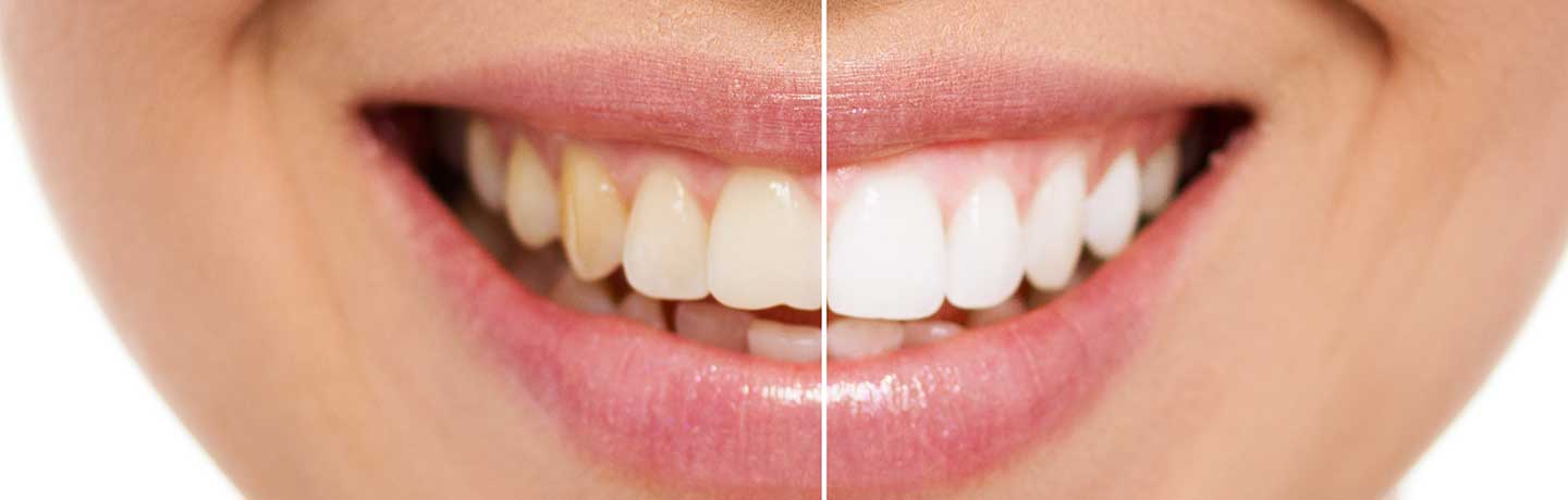 Teeth Whitening Smyrna GA - Teeth Whitening